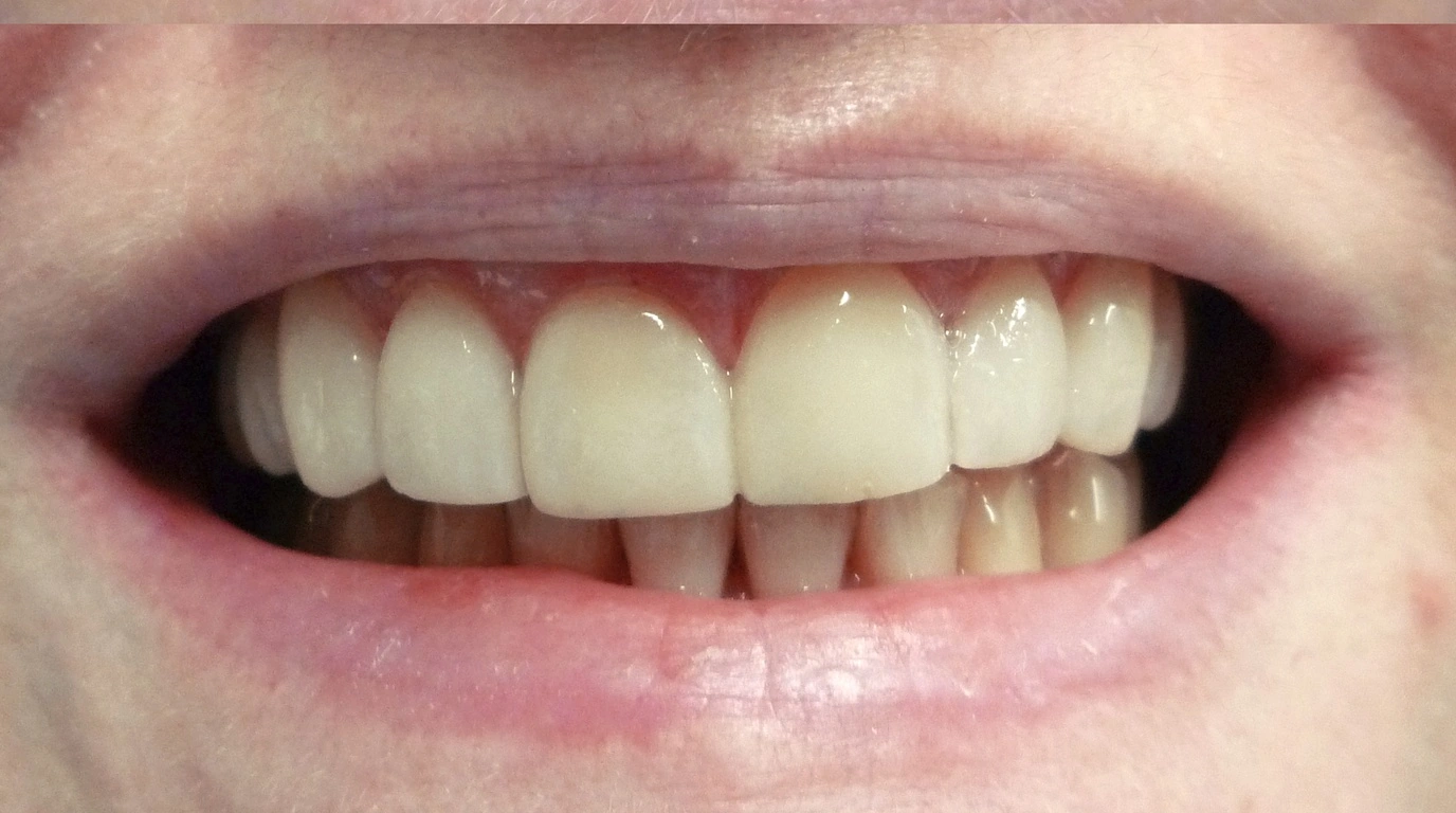 Ergebnis: Keramik-Veneers an sechs Frontzähnen (Nachher)